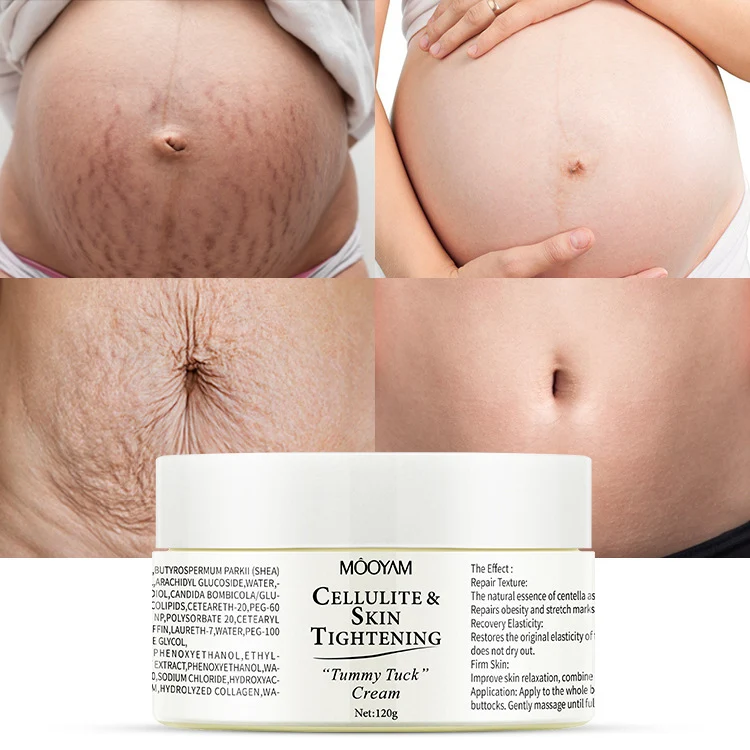 Anti-Striae Crème, Herstel Huidpatroon, Vet Lichaam, Vermindert Striae, Hydrateert en Verbetert Elasticiteit van de Huid. — foto 4