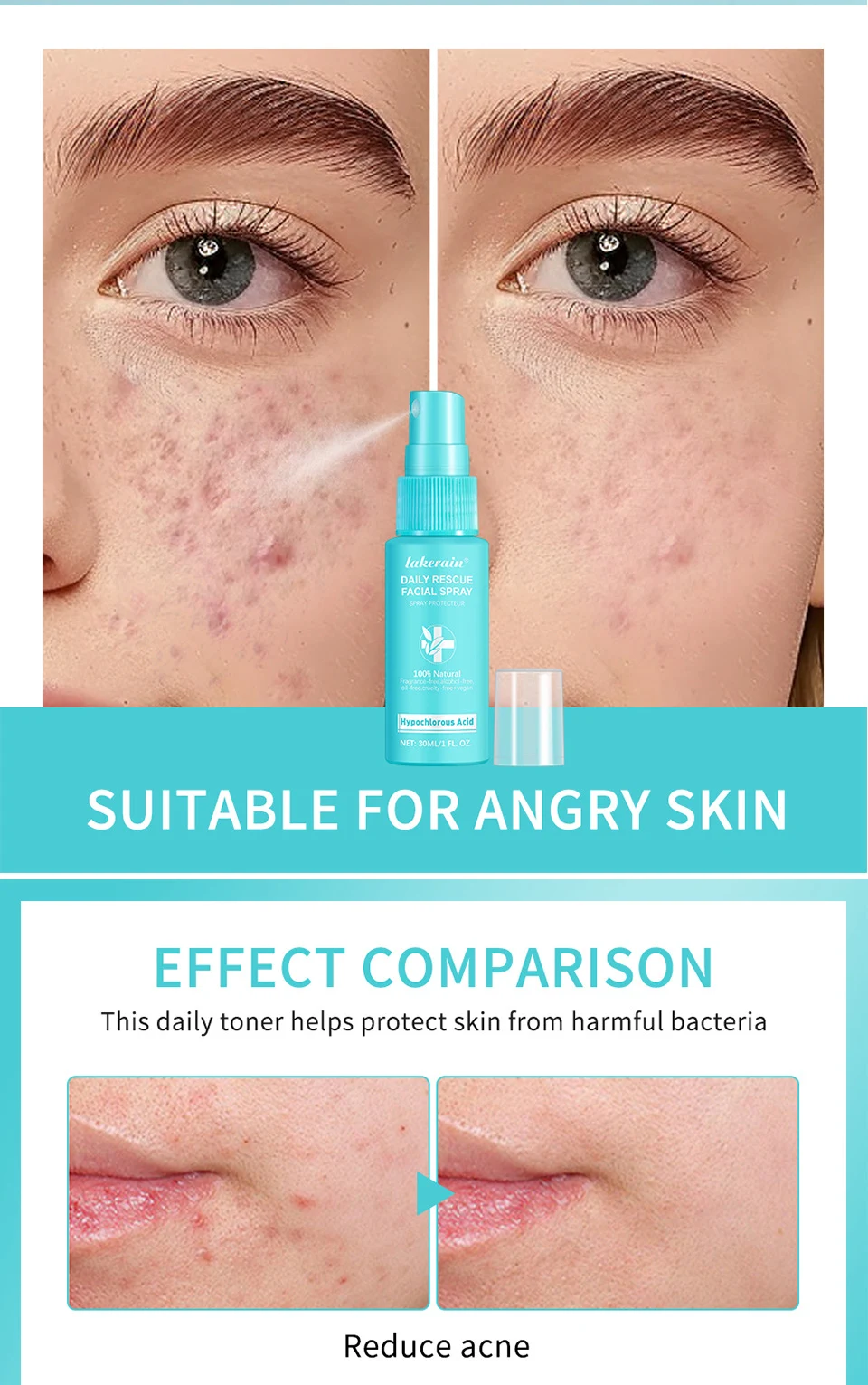 Lakerain Facial First Aid Spray Hipohlorna kiselina za kožu. Umiruje, čisti i štiti. Nežni sprej za lice za osetljivu i iritiranu kožu. — foto 5