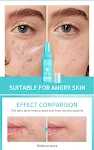 Lakerain Facial First Aid Spray Hipohlorna kiselina za kožu. Umiruje, čisti i štiti. Nežni sprej za lice za osetljivu i iritiranu kožu. — foto 5