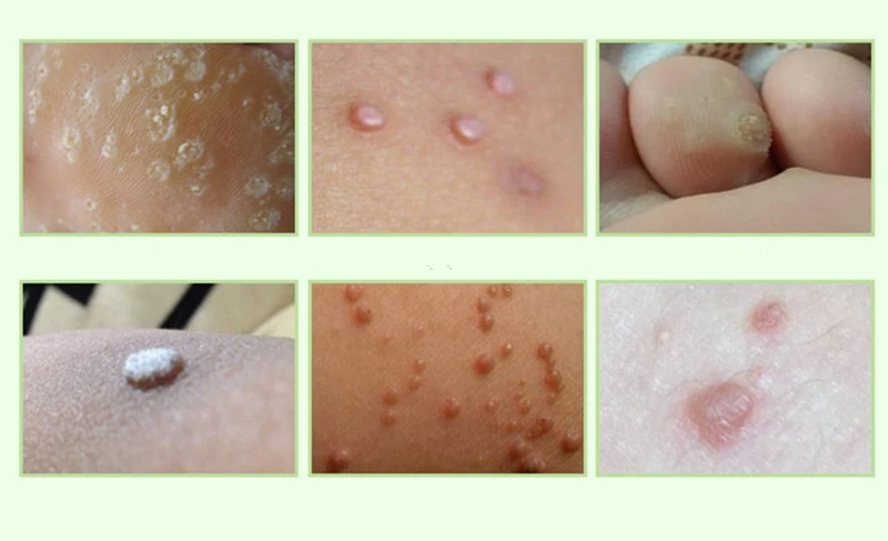 Crema para eliminar callos, verrugas plantares y durezas. Cuidado médico con apósitos. Pies suaves y sanos con nuestro tratamiento. — foto 4