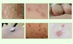 Crema para eliminar callos, verrugas plantares y durezas. Cuidado médico con apósitos. Pies suaves y sanos con nuestro tratamiento. — foto 4