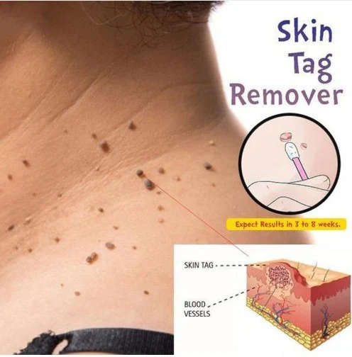 Solução Warts Jingguangping Vegetal para verrugas, calos e verrugas plantares. Tratamento eficaz e seguro. — foto 2