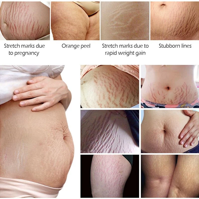 Creme essencial com óleos para remover estrias. Reduz a aparência de estrias, hidrata profundamente e melhora a elasticidade da pele. — foto 6