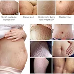 Creme essencial com óleos para remover estrias. Reduz a aparência de estrias, hidrata profundamente e melhora a elasticidade da pele. — foto 6