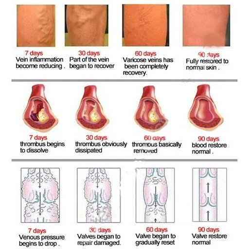 Title 5, VEINS TREATMENT CREAM
