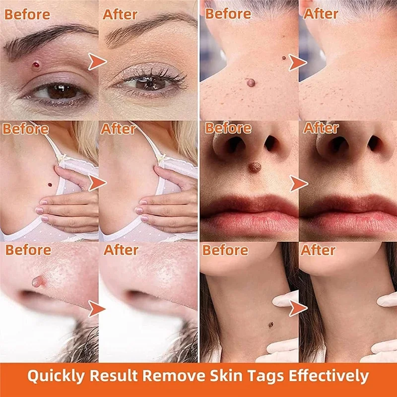 Removedor de Verrugas Faciais Hidratante – Hidrata e Remove Verrugas, Promovendo Pele Macia e Saudável — foto 8