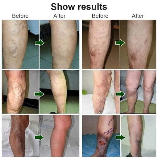 Title 6, VEINS TREATMENT CREAM